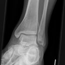 Snowboard fracture Talus