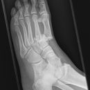 Lisfranc Luxationsfraktur