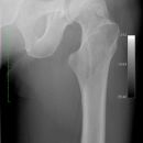 Cam FAI mit herniation pit