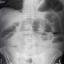 Ileus