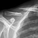 Claviculafraktur im mittleren Drittel