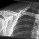 Claviculafraktur im mittleren Drittel