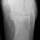Osteomyelitis Calcaneus