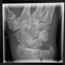 Scaphoid3.jpg
