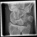 Scaphoid4.jpg